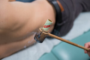 Moxibustion treatment on a patient's back at Asheville Orthopedic Acupuncture