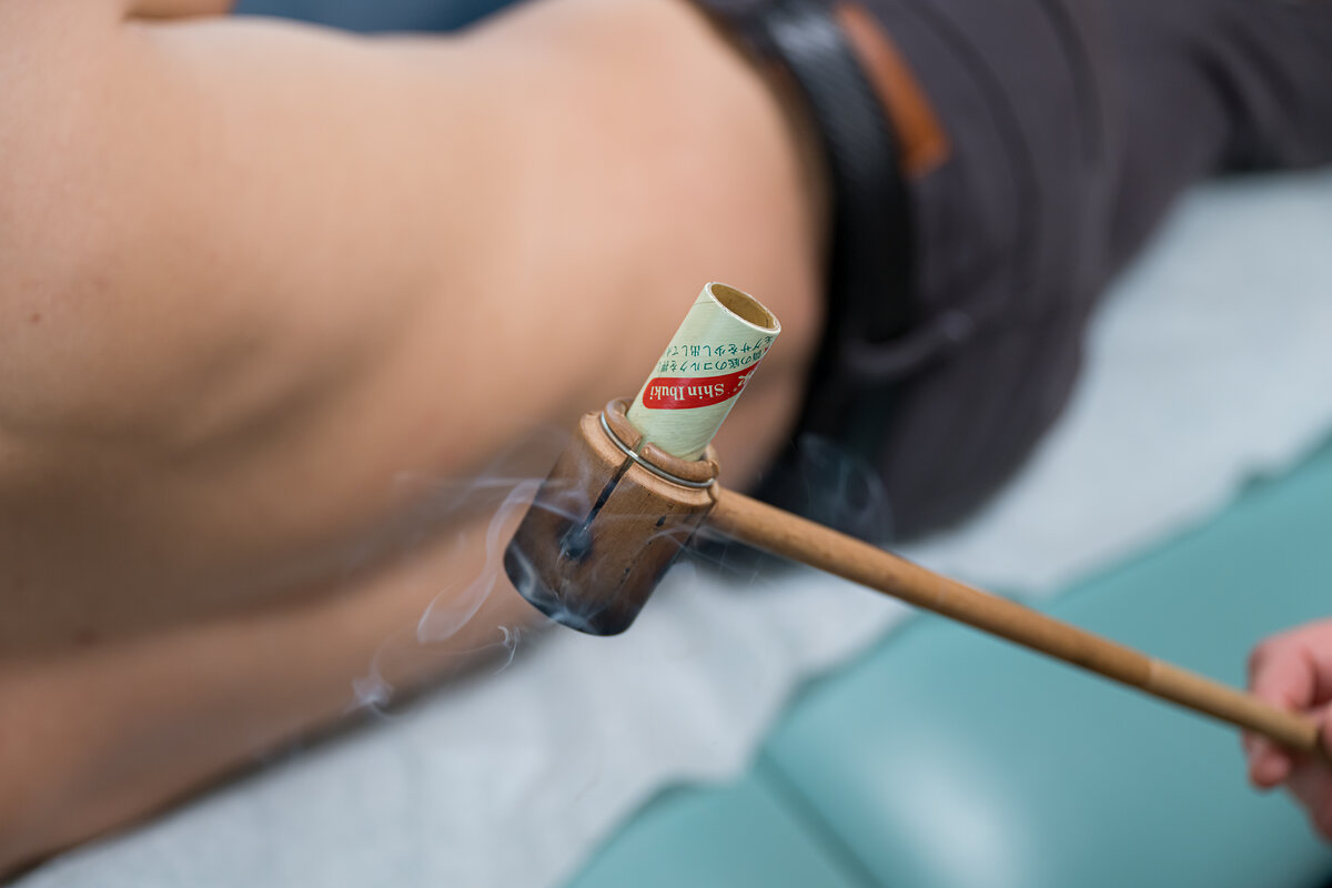 Moxibustion treatment on a patient's back at Asheville Orthopedic Acupuncture