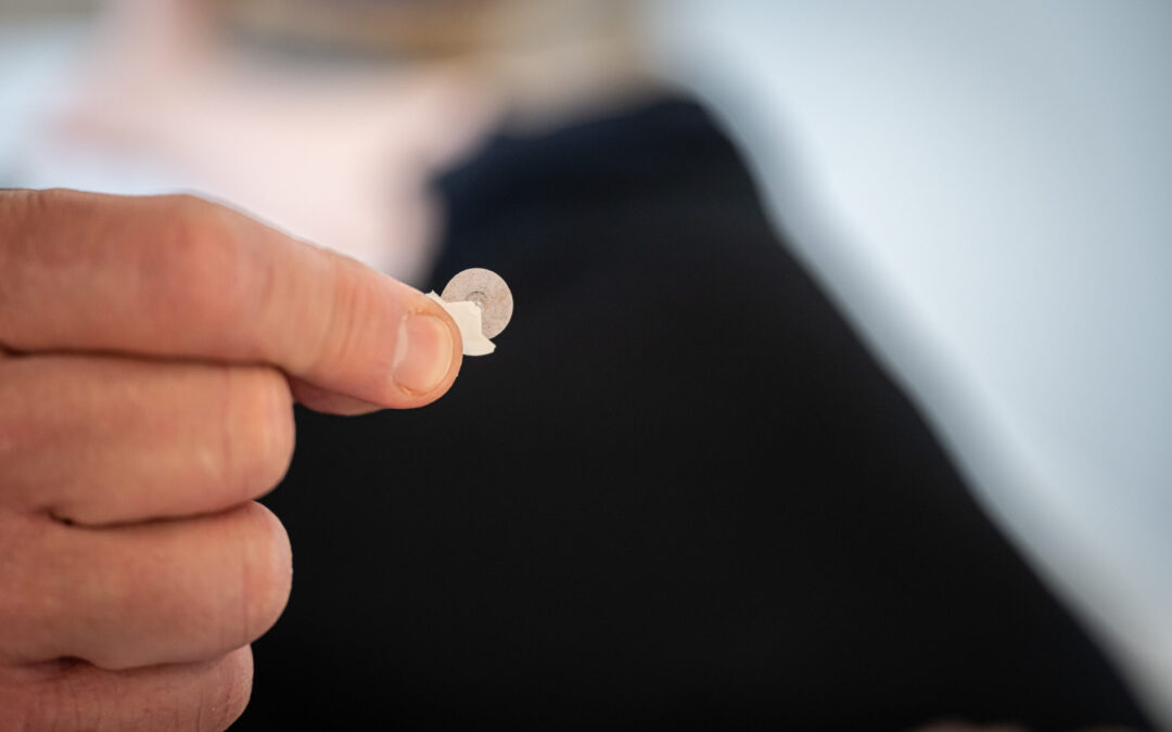 Can Acupuncture Help with Alpha-Gal Syndrome? Here’s What the Research Shows -Alpha-Gal Syndrome Is on the Rise — Especially Here